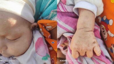 A displaced child in Magway Region’s Pauk Township with a skin infection (Photo: Pauk Township Humanitarian and Disaster Risk Management Department)