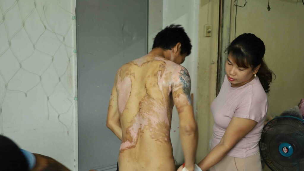 Myanmar migrant worker Thar Thar displays burn wounds he says were inflicted by his Chinese employers during alleged torture in Thailand (Photo: Myanmar Now) 