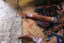 A victim injured in the airstrike on Chinhnit, in Magway Region’s Mindon Township, on October 8 (Photo: Thayet District PDF Battalion 4)