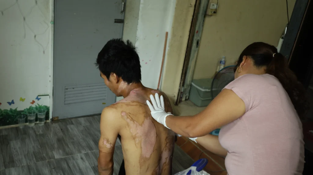 ရေနွေးပူလောင်း နှိပ်စက်ခံရသဖြင့် ရရှိထားသော ကိုသားသား၏ ဒဏ်ရာများကို ဆေးထည့်ပေးနေစဉ်။ (ဓာတ်ပုံ- Myanmar Now)ထိုင်းရောက်ရှမ်းတစ်ယောက်ရဲ့ တရုတ်ငရဲခန်း အတွေ့အကြုံ